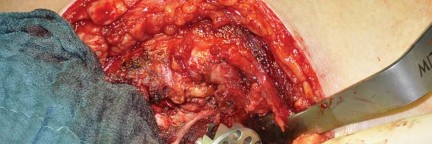 Illustration 54 for Collum Femoris Preserving: Achieve Better Primary Hip Outcomes