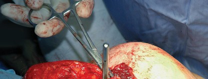 Illustration 51 for Unlock the Figure Posterior Approach to the Hip