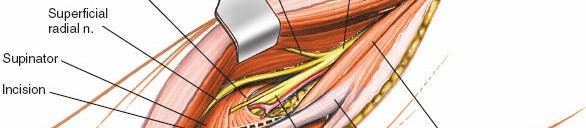Illustration 62 for Mastering Elbow Approaches: Applied Surgical Anatomy for Precision