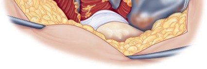 Illustration 52 for Direct Lateral Hip: Optimize Exposure with Sharp Curved Hohmann