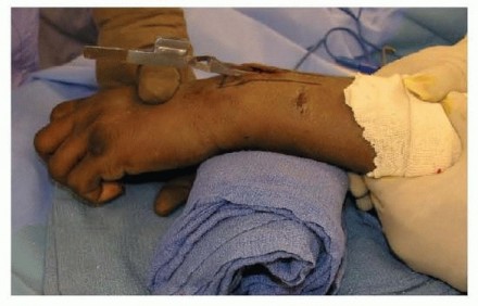 Illustration 10 for Effective K-Wire Fixation: Distal Radius Fractures Without External Fixation