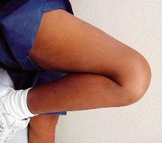 صورة طبية: تقويم مفصل الركبة أحادي الحجرة دليل شامل للمرضى في صنعاء