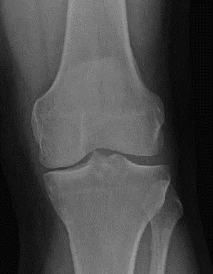 علاج خشونة الركبة الجزئية: مقارنة شاملة بين استبدال المفصل الأحادي وقطع عظم الظنبوب العالي