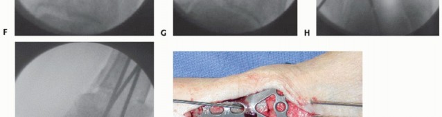 Illustration 6 for Unlock Ankle Preservation: Supramalleolar Closing Wedge Osteotomy