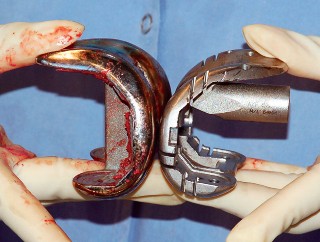 Illustration 37 for Mastering Gap Balancing in Revision TKA: Avoid Common Pitfalls