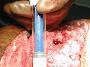 Illustration 14 for Porous Metal Cones: Biologic Fixation for Severe Bone Loss