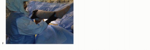 Illustration 26 for Anterior FAI Relief: Mini-Open Anterior Approach Explained