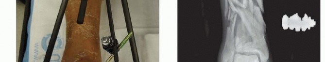 Illustration 44 for Tibia External Fixation: See How Pins Are Placed for Healing