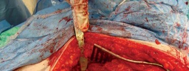 Illustration 142 for Successful Total Hip Replacement in Developmental Dysplasia