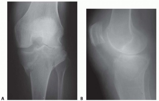 Navigating Bicondylar Tibial Plateau Fractures: A Surgical Guide