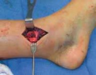 Illustration 12 for Pediatric Ankle Fractures: Management to Prevent Long-Term Issues