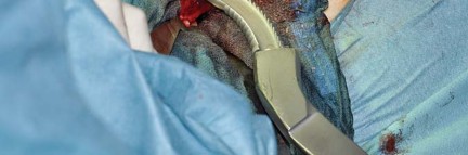 Illustration 38 for Collum Femoris Preserving: Achieve Better Primary Hip Outcomes