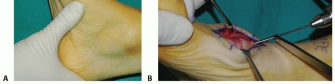 Illustration 11 for Mastering Midfoot Arthrodesis: Protect the Deep Neurovascular Bundle