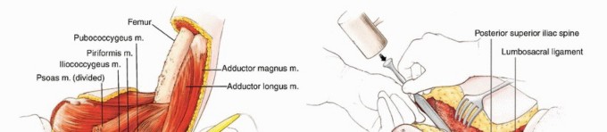Illustration 36 for Anterior Flap Hemipelvectomy: Leveraging fig tech fig for Difficult Tumors