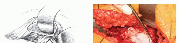 Illustration 9 for Surgical Hip Dislocation Safety: The Branch of the MFCA's Vital Role