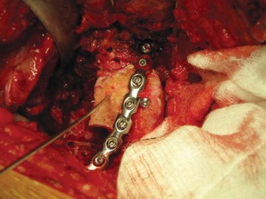 Illustration 24 for Navigating Early THA for Fractures of the Acetabulum