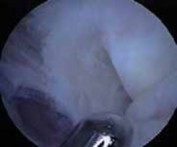 Solving Arthroscopic Valgus Instability: Regain Elbow Stability