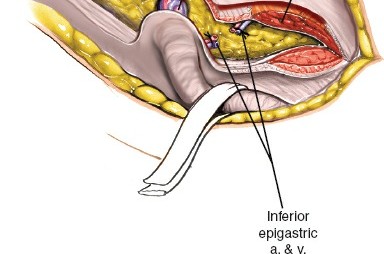 Illustration 15 for Ilioinguinal Approach: Master the Deep Inguinal Ring for Success
