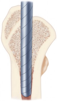 Illustration 30 for Cementless Femoral Stems: Master Indications & Avoid Pitfalls