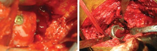 Illustration 23 for Total Hip Arthroplasty: Restoring Mobility in Juvenile Idiopathic Arthritis