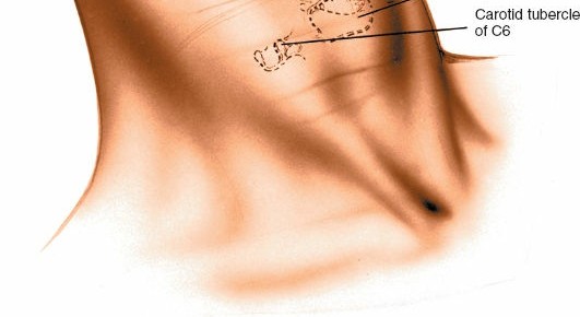 Illustration 4 for Mastering the Anterior Cervical Approach: Longus Colli Muscle Insights