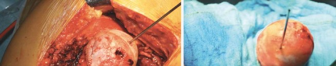 Illustration 78 for Birmingham Hip Resurfacing Designer's Technique for Active Lives