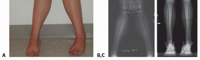 Illustration 4 for Optimizing Growth to Correct Pediatric Limb Deformities