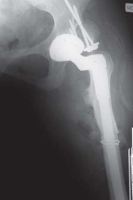 Illustration 34 for Successful Total Hip Replacement in Developmental Dysplasia