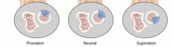 Illustration 2 for Radial Head & Neck Fractures: Mastering ORIF for Best Results
