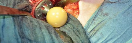 Illustration 70 for Collum Femoris Preserving: Achieve Better Primary Hip Outcomes