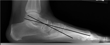 Illustration 105 for First Metatarsal Surgery: Expert Solutions for Foot & Ankle Pain