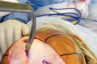 صورة طبية: استبدال مفصل الركبة بالحد الأدنى من التدخل الجراحي: ألم أقل وتعافٍ أسرع مع النهج شبه الرضفي الإنسي