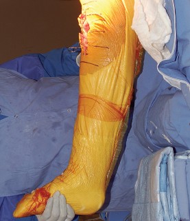 Illustration 64 for Mastering Gap Balancing in Revision TKA: Avoid Common Pitfalls