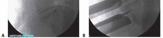 Illustration 6 for Anterior Lumbar Interbody: Fusion, Disc Replacement & Pain Relief
