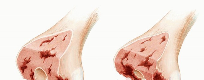 Illustration 2 for Optimizing Revision Femoral Component with Distal Femoral Bone Loss