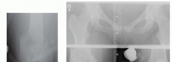 Illustration 41 for Repairing Distal Femur Fractures: Open Reduction & Internal Fixation