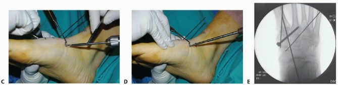 Illustration 18 for Mastering Midfoot Arthrodesis: Protect the Deep Neurovascular Bundle