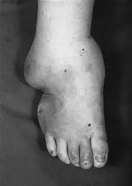 صورة توضيحية لـ مفصل شاركو: دليل شامل لعلاج القدم السكرية في صنعاء | د. هطيف