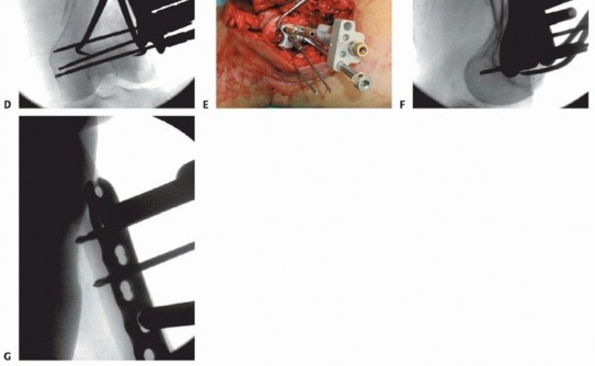 Illustration 51 for Repairing Distal Femur Fractures: Open Reduction & Internal Fixation