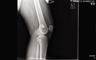 Diagnostic Dilemma: Unpacking Oncology Cases Enchondroma