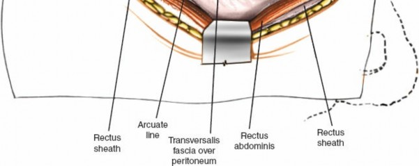 Illustration 14 for Expert Guide: Transperitoneal and Retroperitoneal Lumbar Access