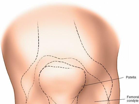 Illustration 5 for Mastering Knee Approaches: Spotlight on Superficial Medial Ligament