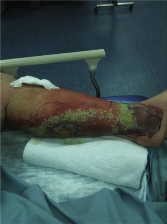 Mastering Necrotizing Soft Tissue Diagnosis with LRINEC Criteria