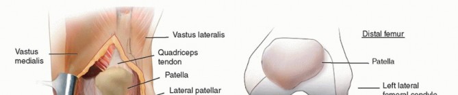 Tibial Tubercle Osteotomy: The Key to Extensile Exposure in Revision TKA