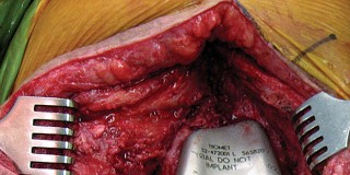 Illustration 42 for Hinged Total Knee: The Salvage Solution for Challenging Cases