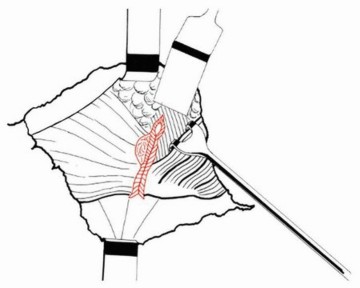 Illustration 21 for Sliding Trochanteric Osteotomy: Modern Role & Refined Techniques