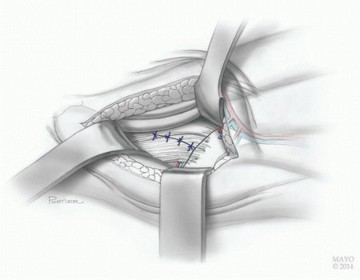 صورة طبية: النهج الأمامي لاستبدال مفصل الورك الكلي: ثورة في جراحة الورك مع الأستاذ الدكتور محمد هطيف في صنعاء