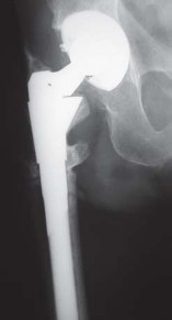 Illustration 49 for S-ROM: Inside the Technique of Modular Implant Design