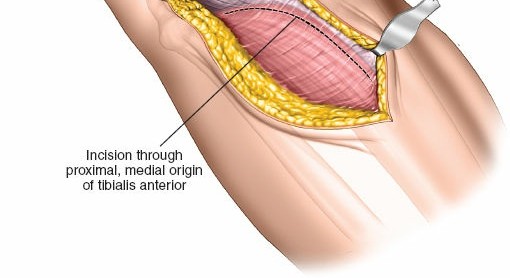 Illustration 12 for Surgical Access: Mastering the Tibia's Surface & Fibula Approaches
