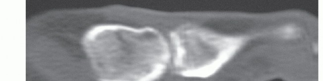 Illustration 6 for Optimizing Internal Fixation of Sesamoid Fractures
